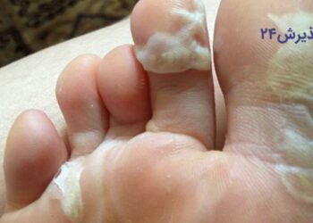 پوسته پوسته شدن کف پا در پیاده روی اربعین